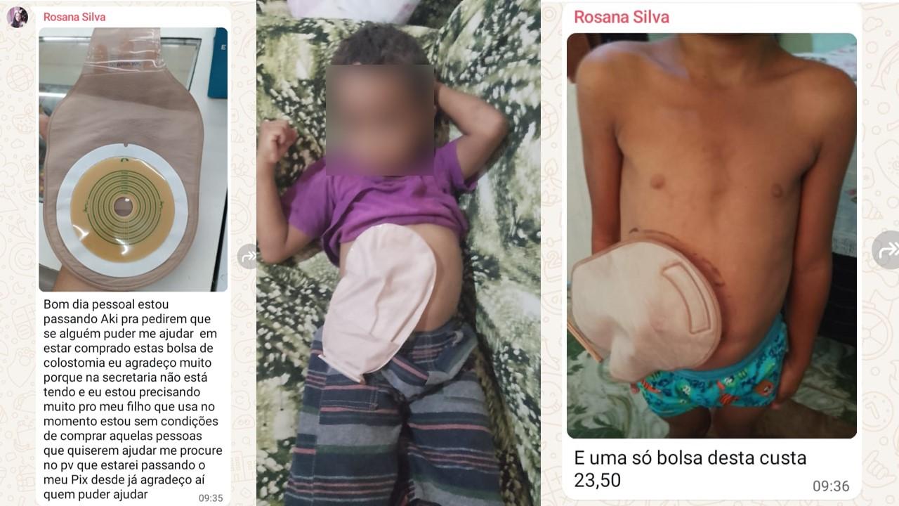 Criança de 6 anos depende de bolsas de colostomia para sobreviver em Itanhém; mãe está encontrando dificuldades na gestão de Bentivi