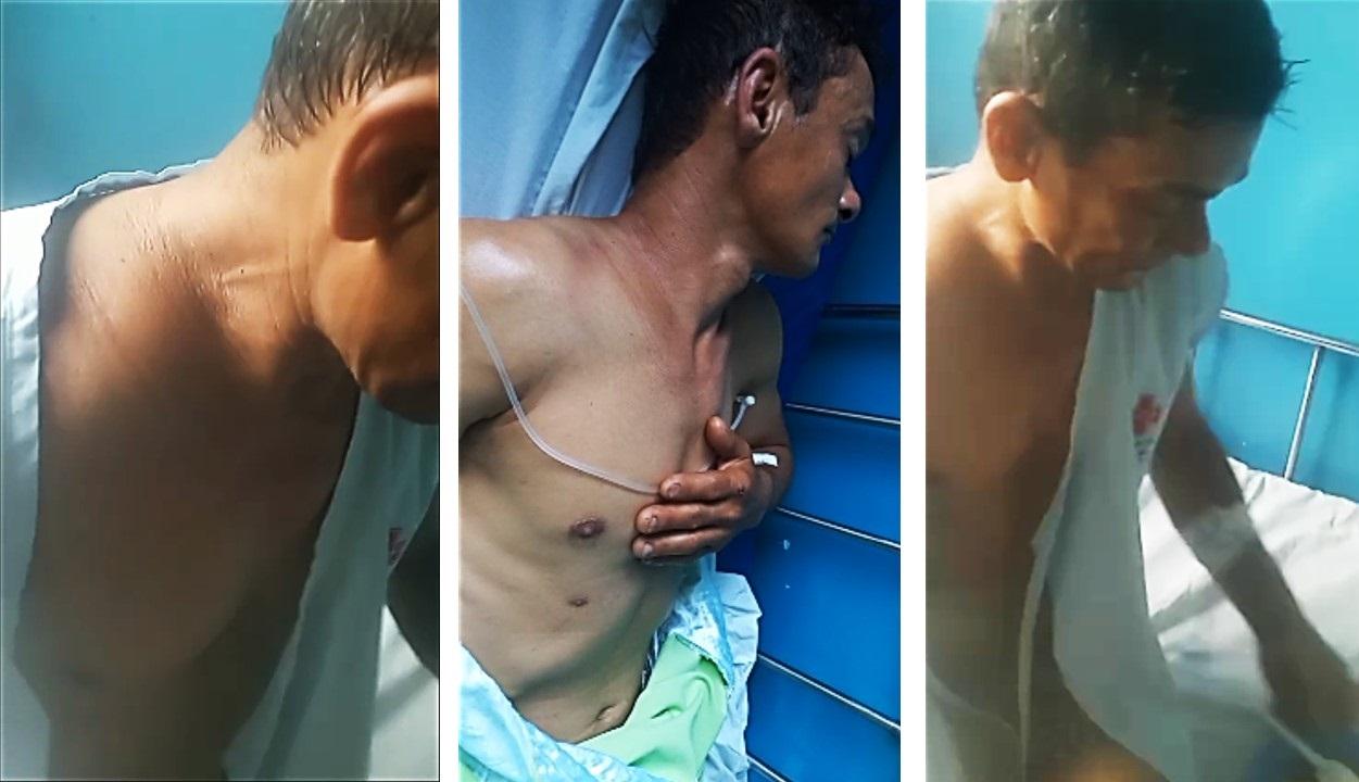 Morador de Vila Resende, com clavícula quebrada, é mandado para casa e família se revolta com a falta de cirurgia há 20 dias