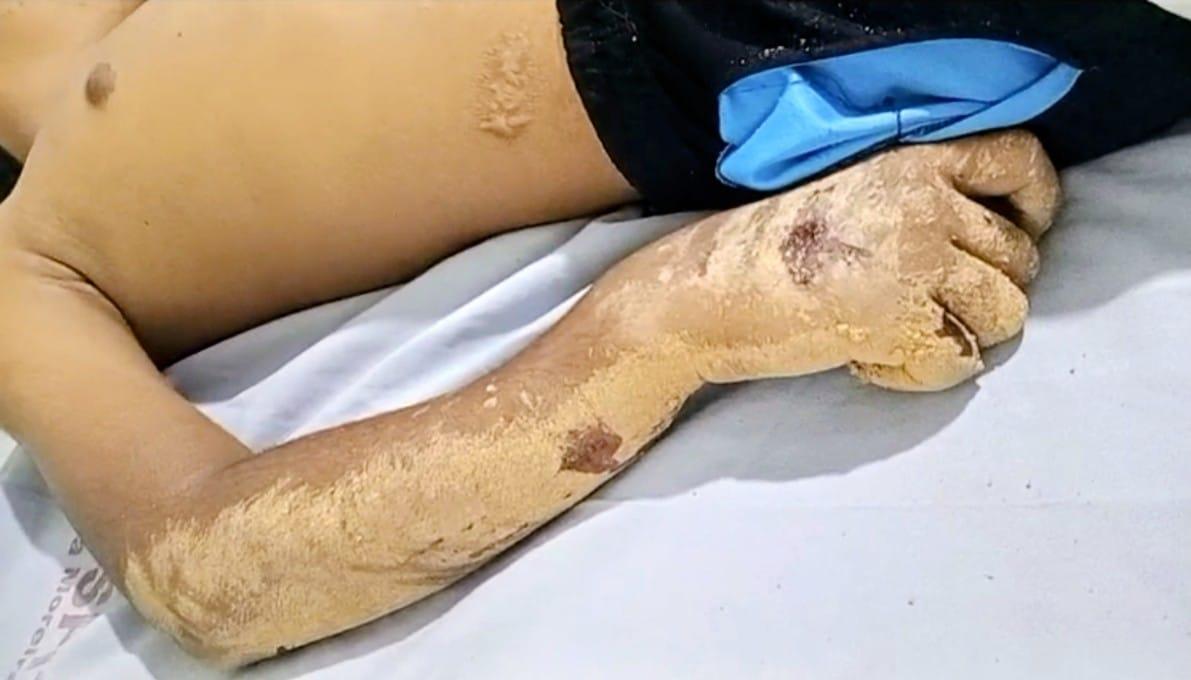 Adolescente com duas fraturas aguarda transferência para Teixeira de Freitas; falta de ortopedista no hospital de Itanhém pode agravar o quadro