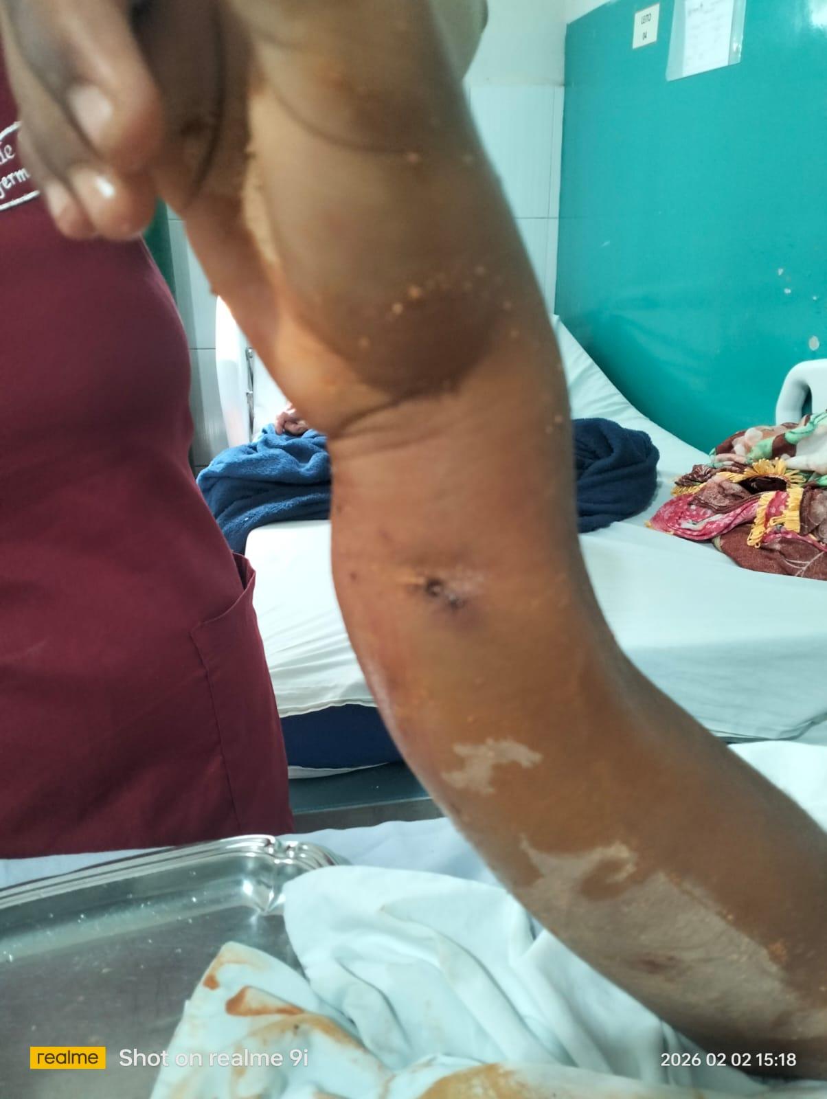 Adolescente com o braço fraturado.