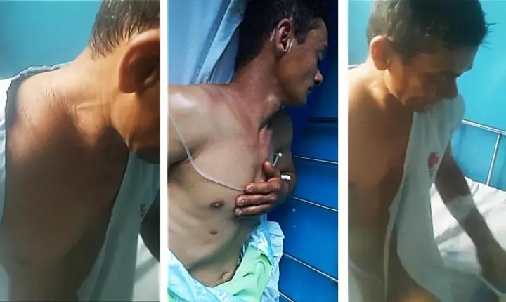 Morador de Vila Resende, com clavícula quebrada, é mandado para casa e família se revolta com a falta de cirurgia há 20 dias